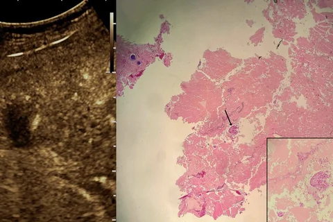 Locoregional therapy rendering