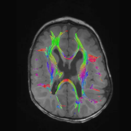 DTI Tractography overlaid on axial MR slice