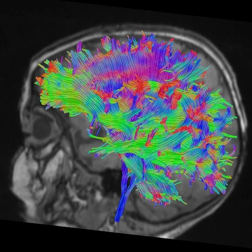 Whole brain DTI Tractography with sagittal MR