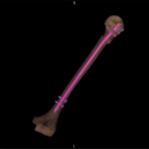 Humerus with rod